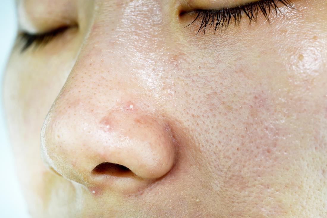 Should You Moisturize If You Have Oily Skin?